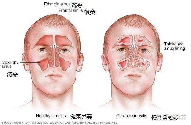 Can鼻窦炎患者盖羽绒被？